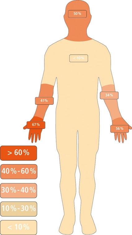 Verteilung der Hautverbrennungen bei Lichtbogenunfällen auf die verschiedenen...