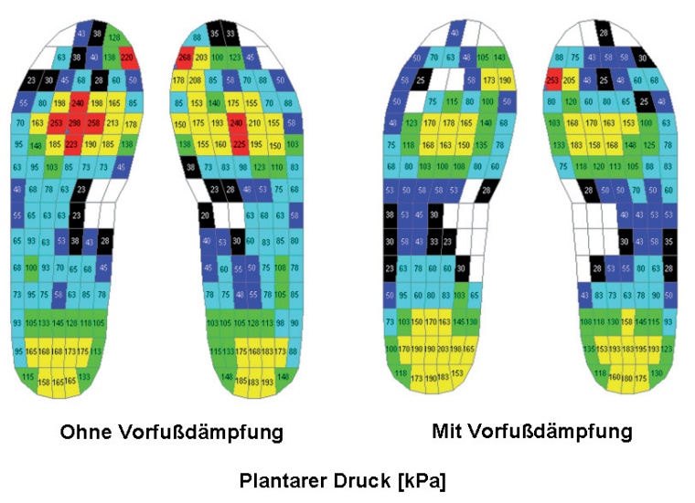 Proband, 52 Jahre mit leichtem Hallux valgus und zeitweisen Schmerzen im...